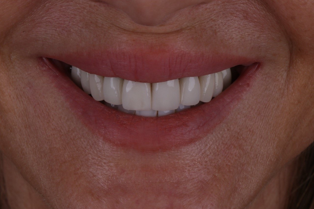 Un sorriso prima del trattamento restauro in ceramica