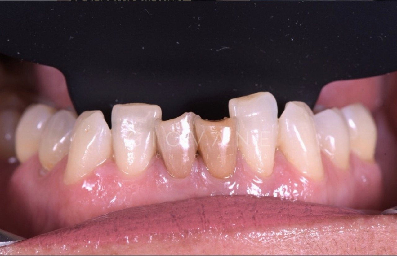 Un sorriso prima del trattamento estetica in un giorno
