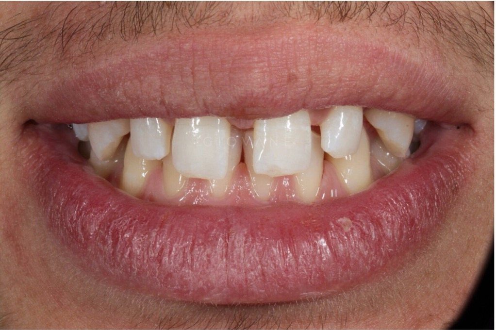 Il sorriso di Giacomo prima del trattamento