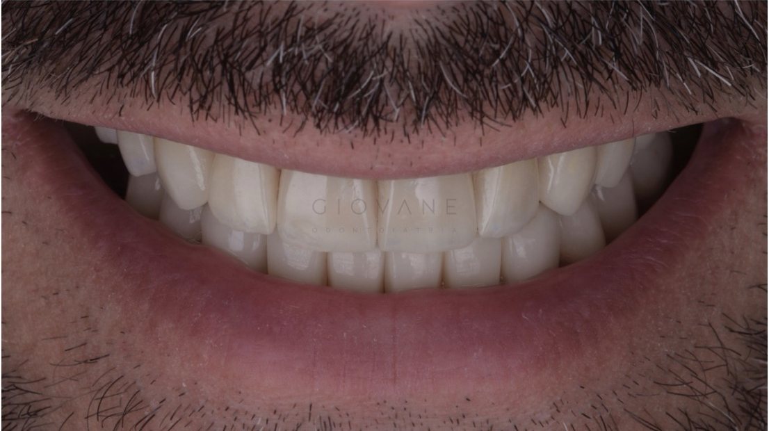 Il sorriso di Giovanni dopo il trattamento