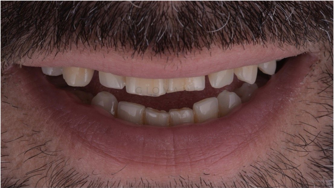 Il sorriso di Giovanni prima del trattamento