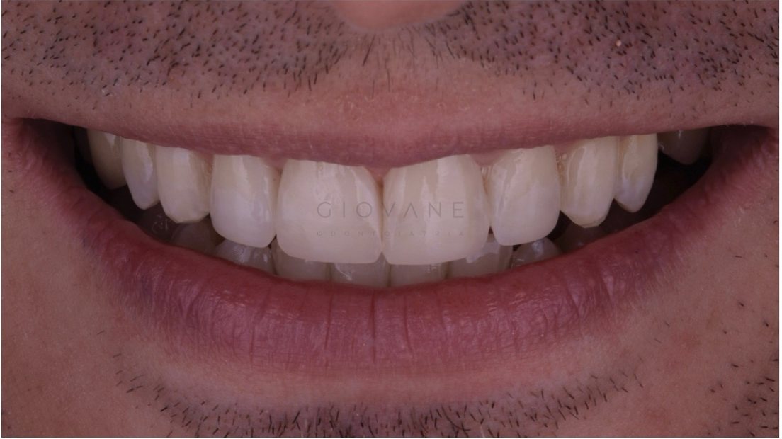 Il sorriso di Marco dopo il trattamento