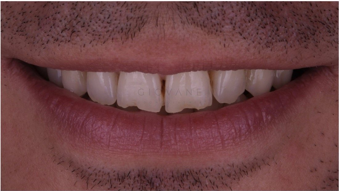 Il sorriso di Marco prima del trattamento