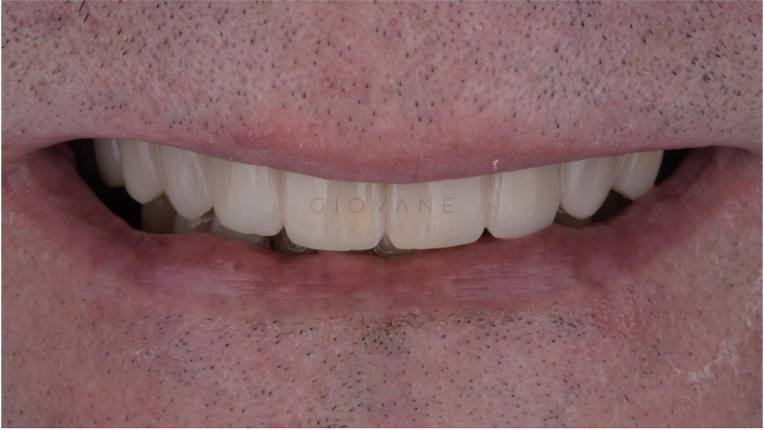 Il sorriso di Mario dopo il trattamento