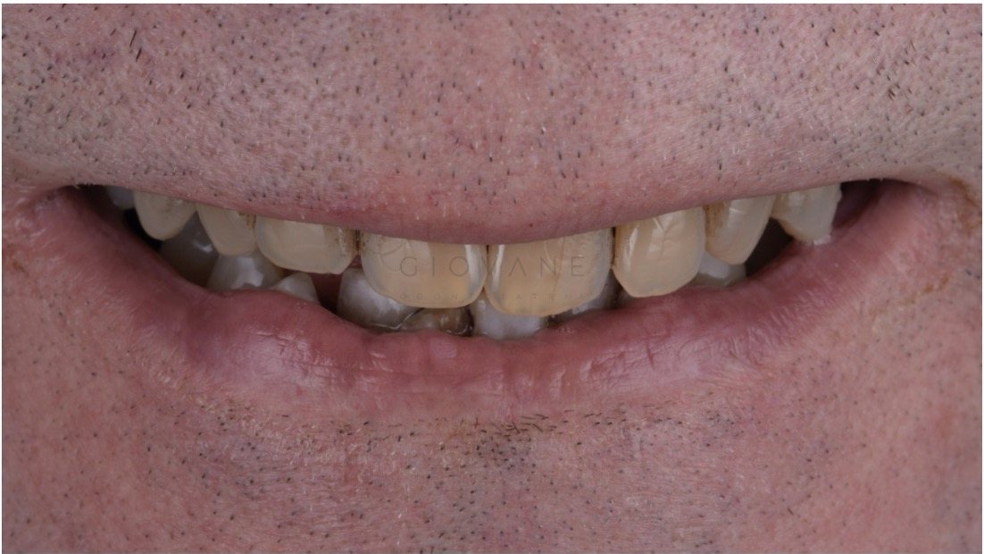 Il sorriso di Mario prima del trattamento