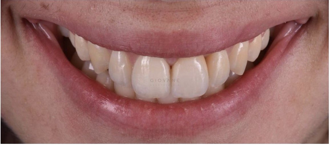 Il sorriso di Sara dopo il trattamento