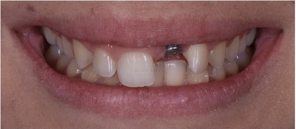 Il sorriso di Sara prima del trattamento