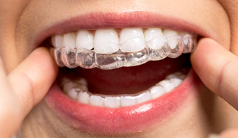 Invisalign Clear Braces