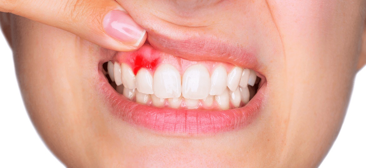 Sanguinamento Gengive Dimensioni Grandi