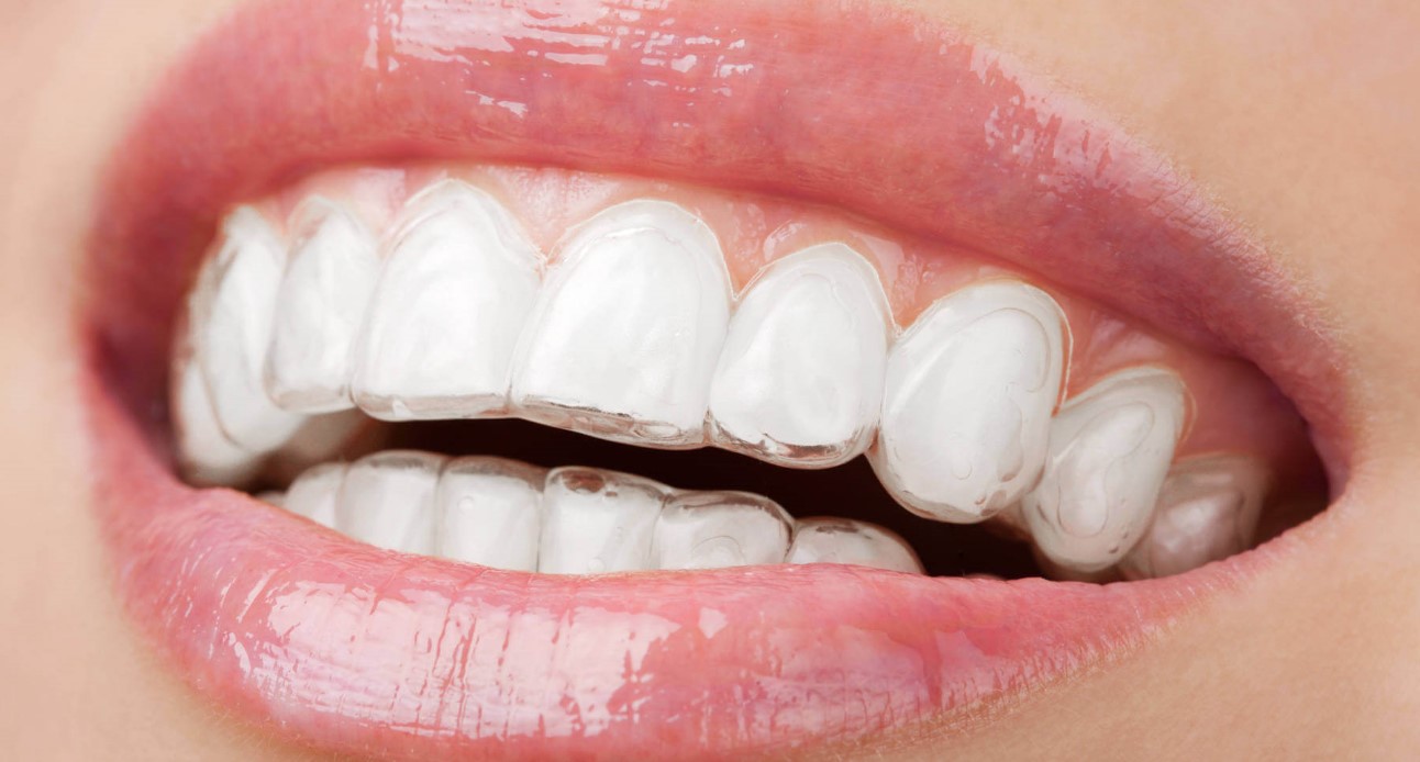 Ortodonzia Apparecchio Denti Invisibile Velletri